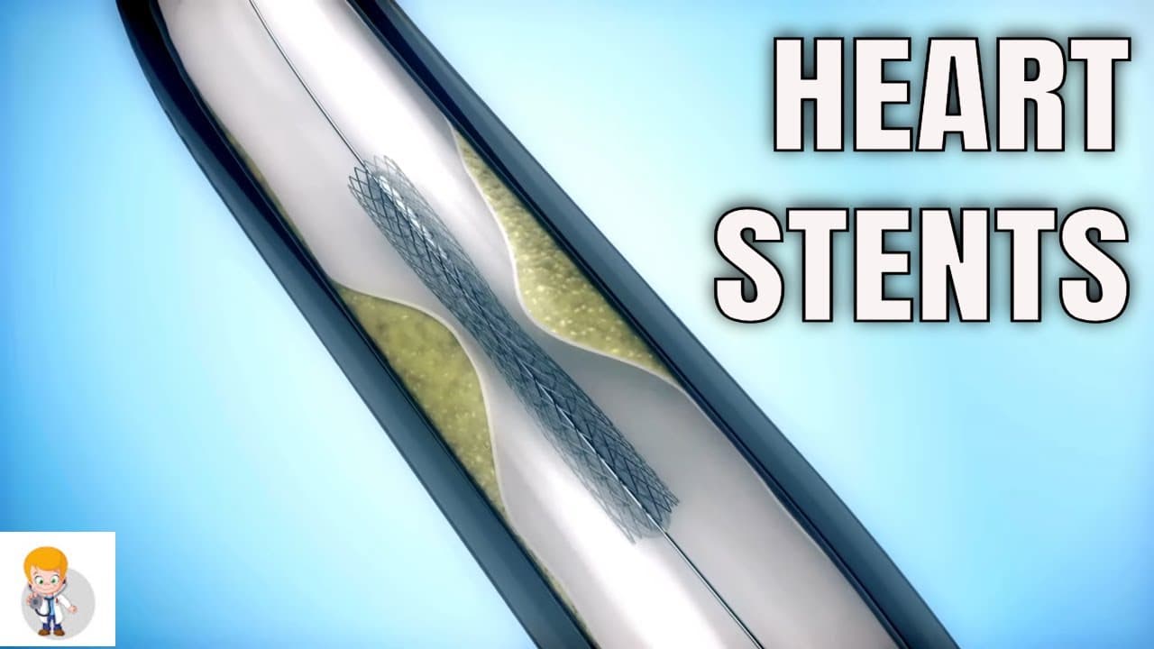 Drug-eluting stents (DES) Vs. Bare metal stents (BMS)