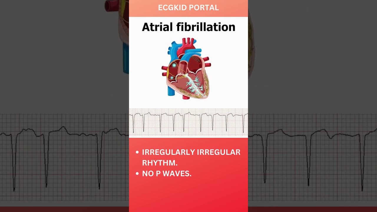 Atrial Fibrillation Anatomy, ECG #icu #medicine #emergencymedicine #atrialfibrillation