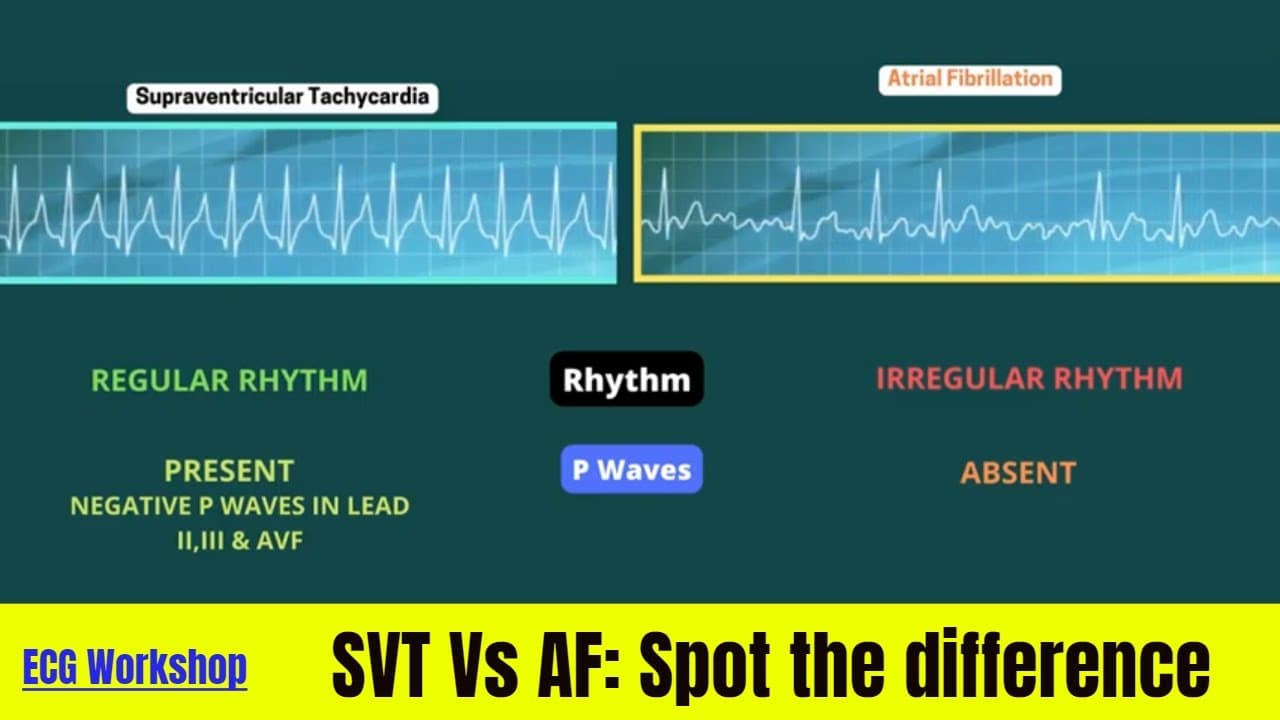 ECG Workshop: SVT & AF on simulation