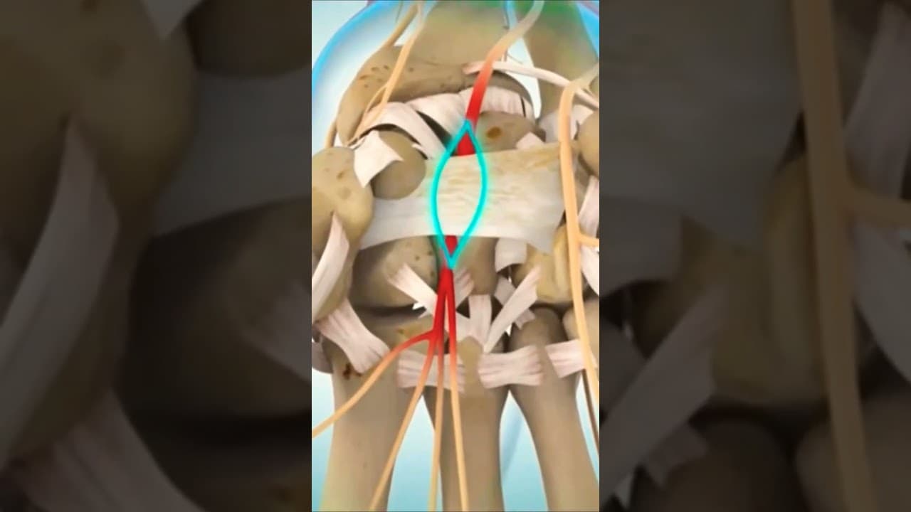 carpal tunnel syndrome #surgery #medicalstudent #medicine
