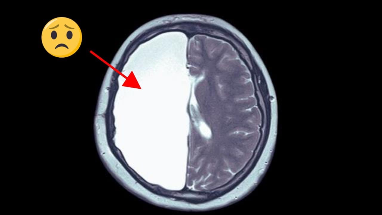 What Happens When We Remove Half of Your Brain? 🧠 Neuroplasticity Explained!
