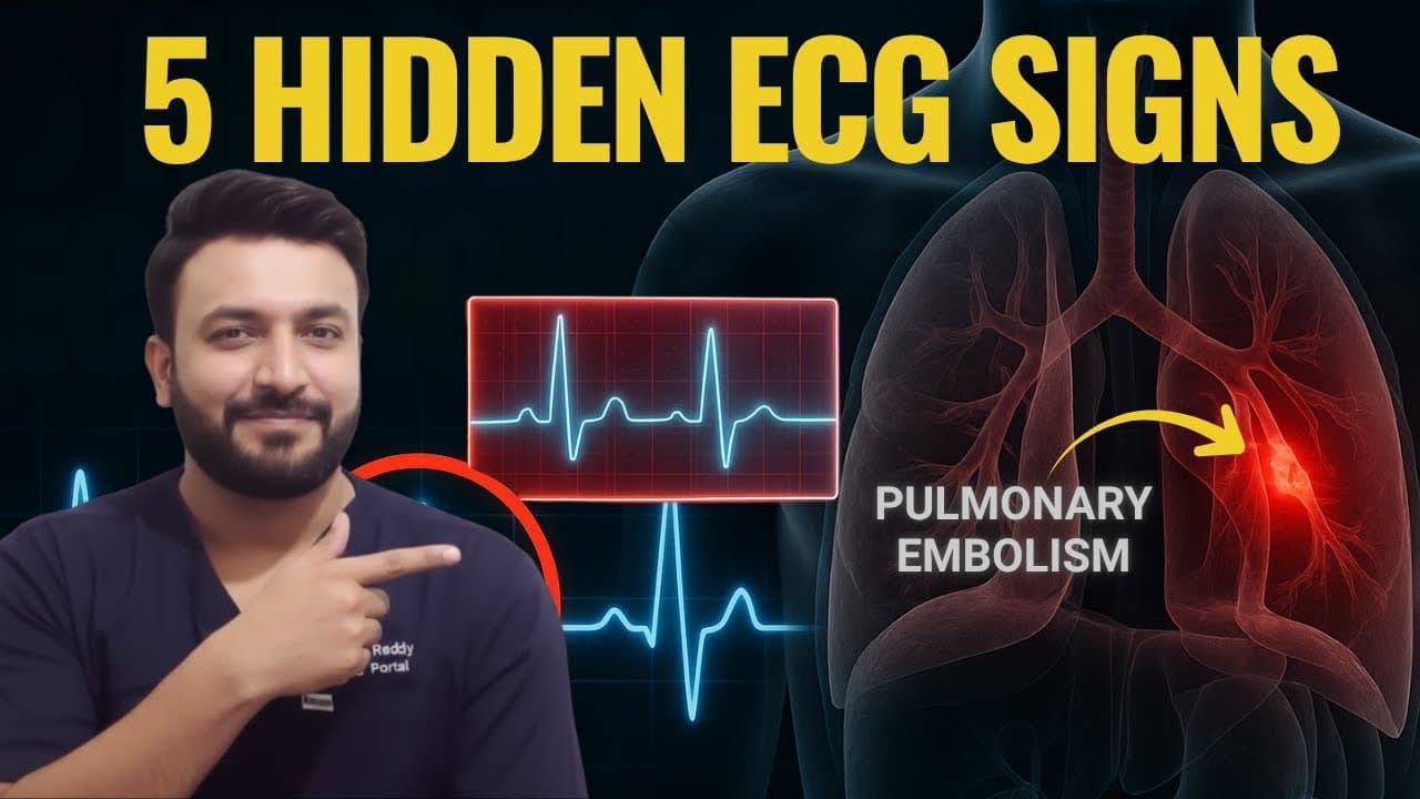 5 Hidden ECG Signs of Pulmonary Embolism: Spot PE in Minutes