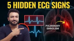 5 Hidden ECG Signs of Pulmonary Embolism: Spot PE in Minutes