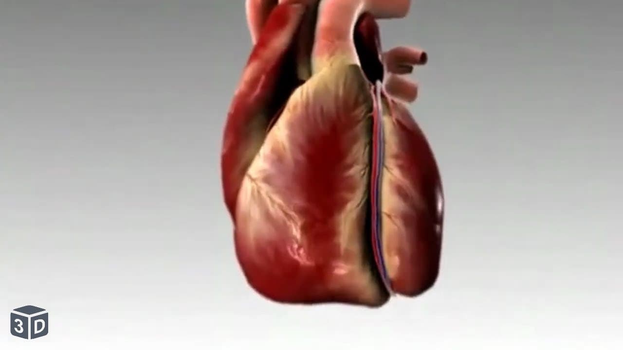Heart attack and congestive Heart Failure in 3D