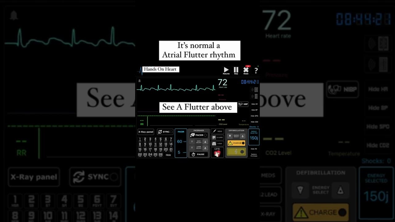 What is the rhythm #medicaleducation #doctor #ecg #cardiac #neurology