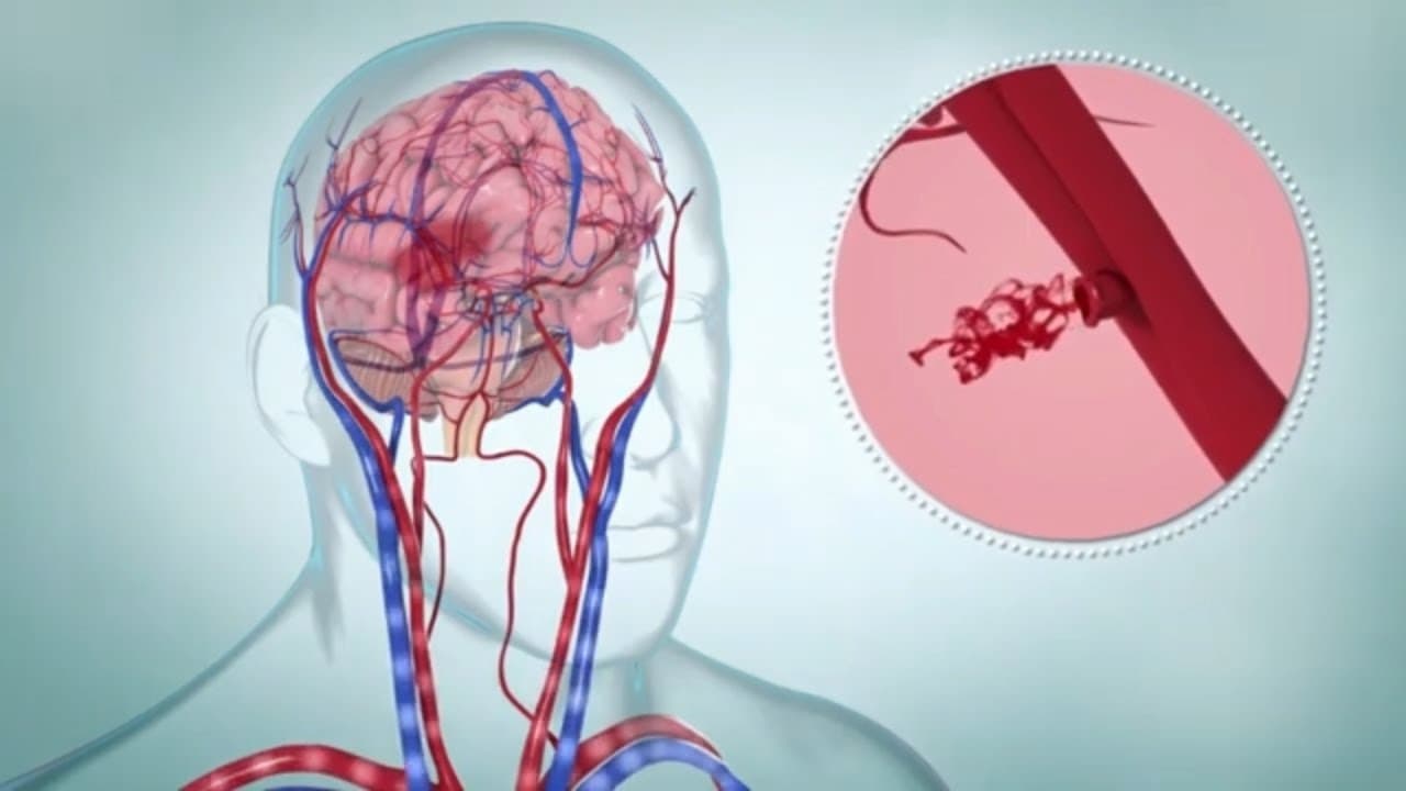 Hemorrhagic Stroke Explained | Causes, Symptoms & Treatment (Medical Animation)