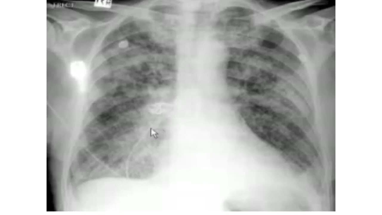 Pulmonary edema: X-Ray review