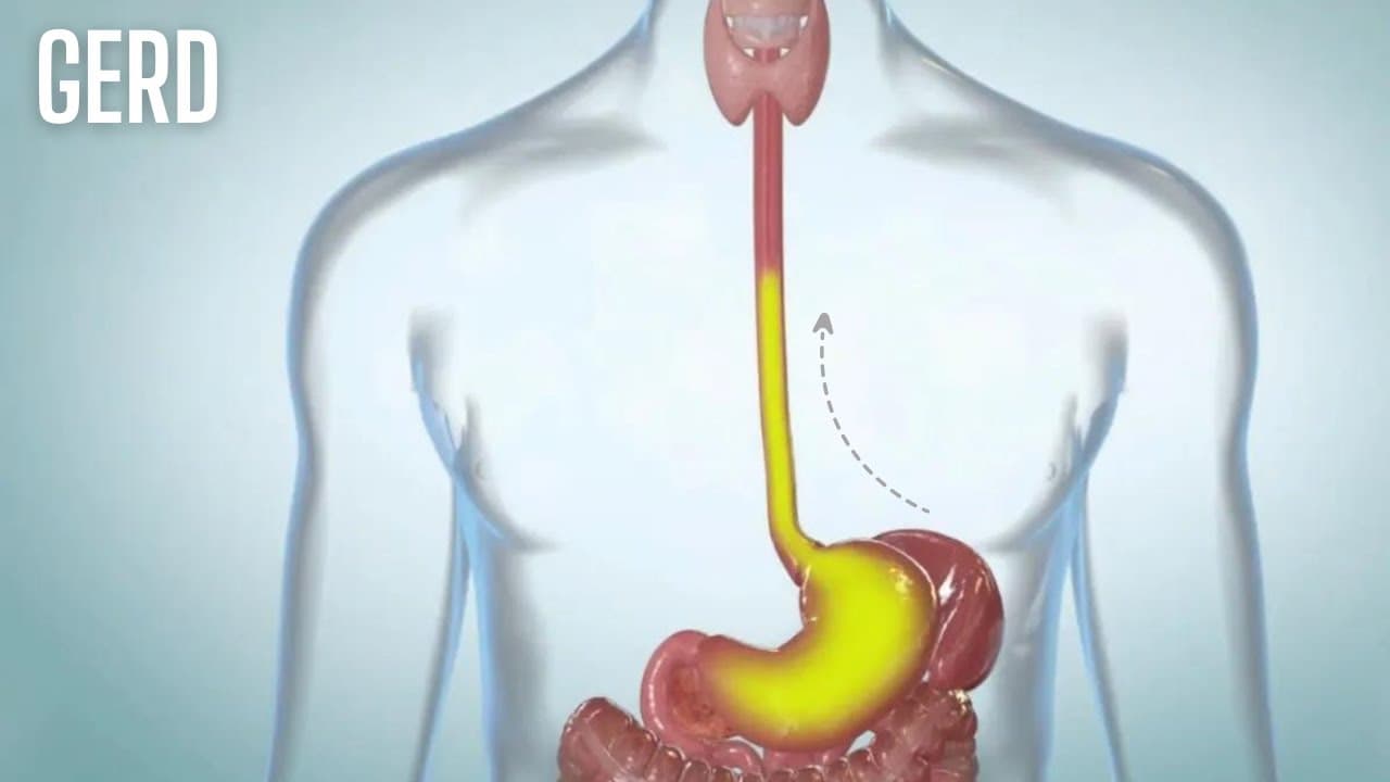 What is Gastroesophageal reflux disease (GERD)?