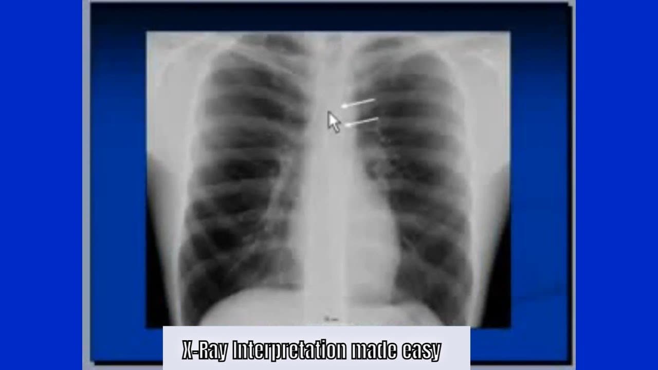Chest X-Ray Interpretation: Step-by-Step Guide for Medical Professionals