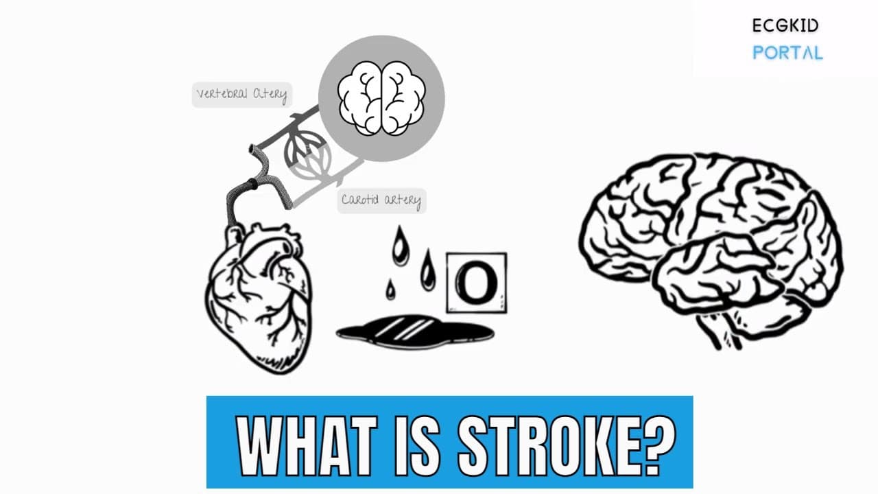 What is Stroke or CVA?