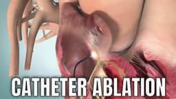 Catheter ablation for cardiac arrythmias & atrial fibrillation