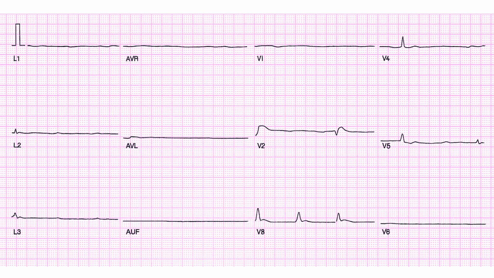 Pulseless Electrical Activity (PEA): Advanced ECG Recognition and Emergency Management