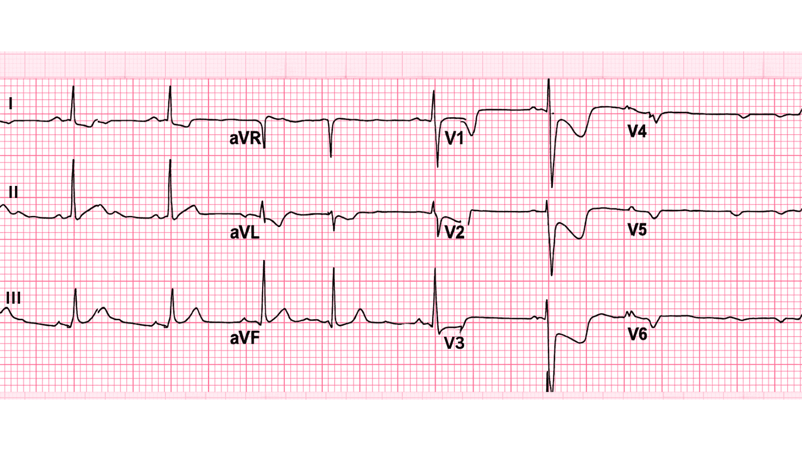 Posterior Wall Myocardial Infarction: Advanced ECG Recognition and Emergency Management
