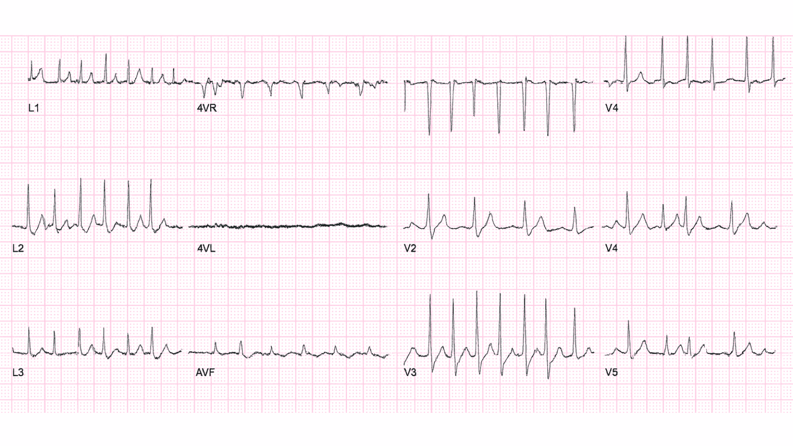 Supraventricular Tachycardia (SVT): Advanced ECG Recognition and Emergency Management