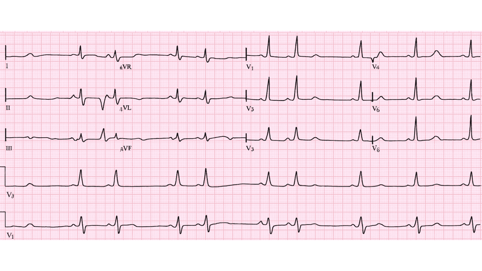 Second Degree AV Block Mobitz Type II: Advanced ECG Recognition and Emergency Management