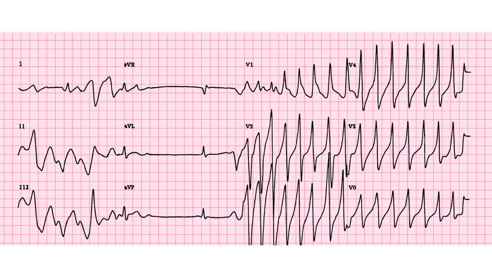 Torsades de Pointes: Advanced ECG Recognition and Emergency Management