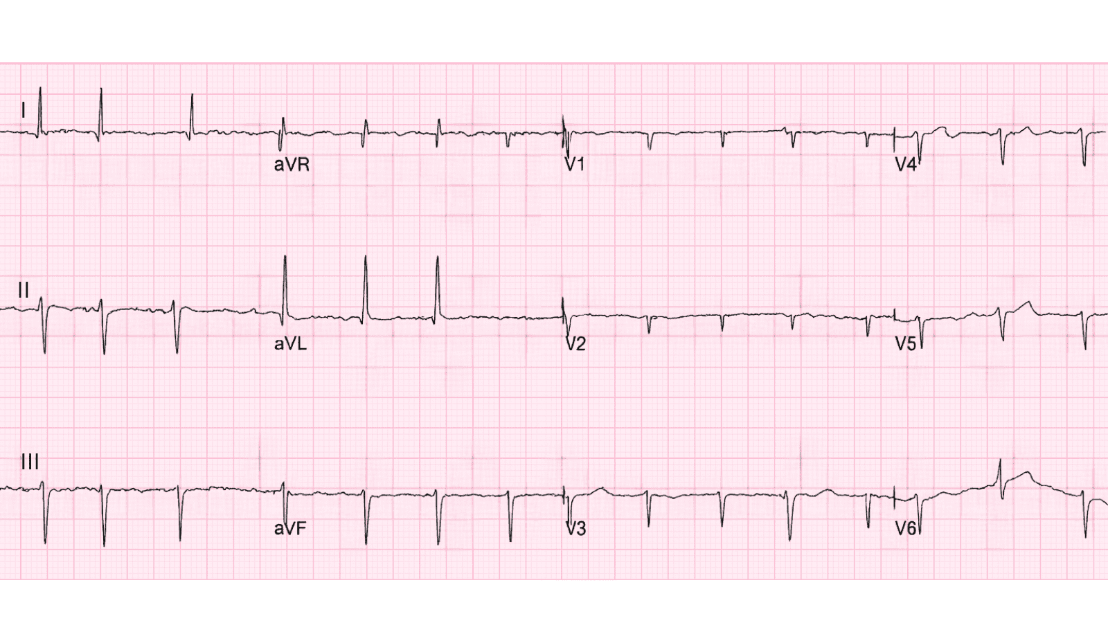 Wandering Atrial Pacemaker (WAP): Advanced ECG Recognition and Emergency Management