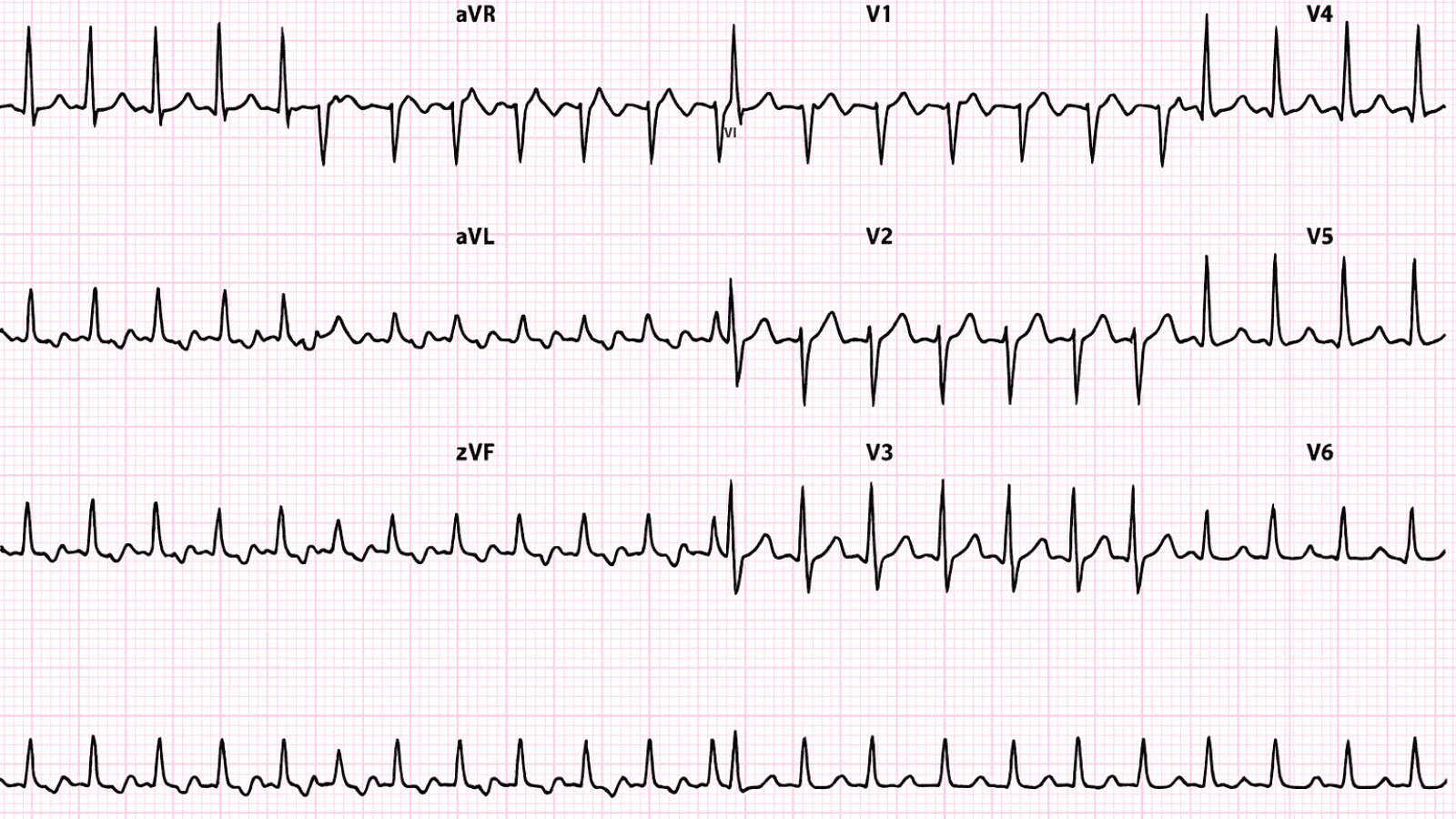 Wolff-Parkinson-White Syndrome (WPW): Advanced ECG Recognition and Emergency Management