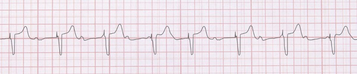 Ventricular Paced Rhythm: ECG Recognition and Emergency Management