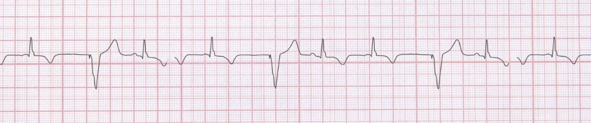 Premature Ventricular Contractions: ECG Recognition and Clinical Management