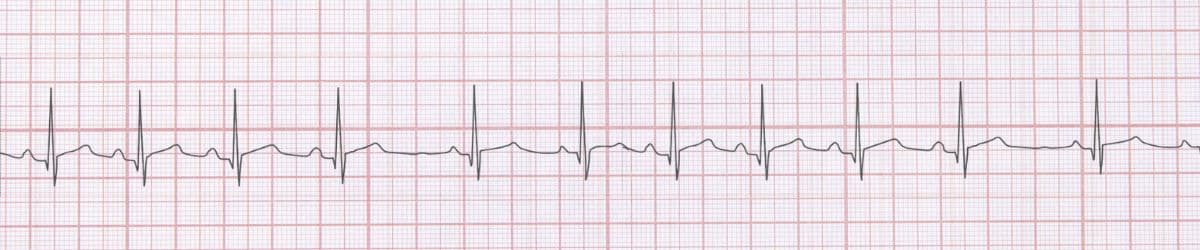 Sinus Arrhythmia: ECG Recognition and Clinical Management