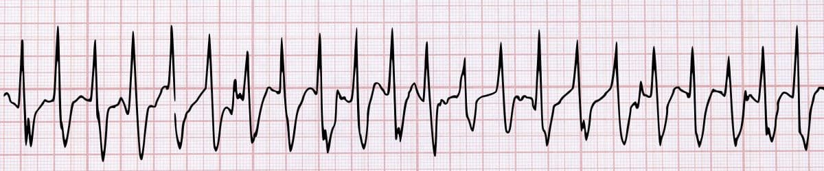 Supraventricular Tachycardia: ECG Recognition and Clinical Management