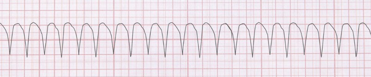 Ventricular Tachycardia: ECG Recognition and Clinical Management